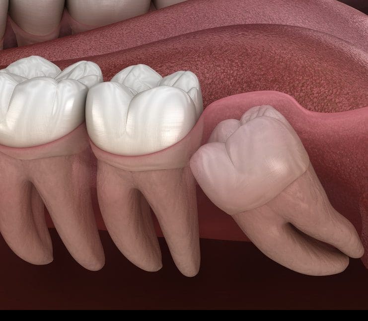 Common wisdom tooth problem and how to deal with them
