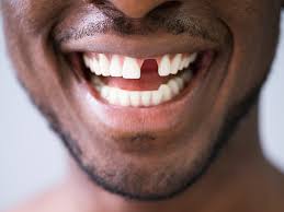 3 Cheapest Options to Replace a Missing Tooth (2026 Cost Guide)